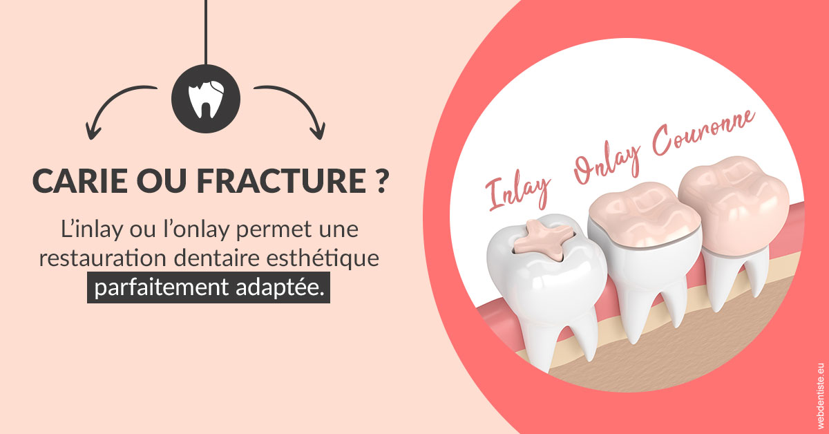 https://dr-brincat-thierry.chirurgiens-dentistes.fr/T2 2023 - Carie ou fracture 2