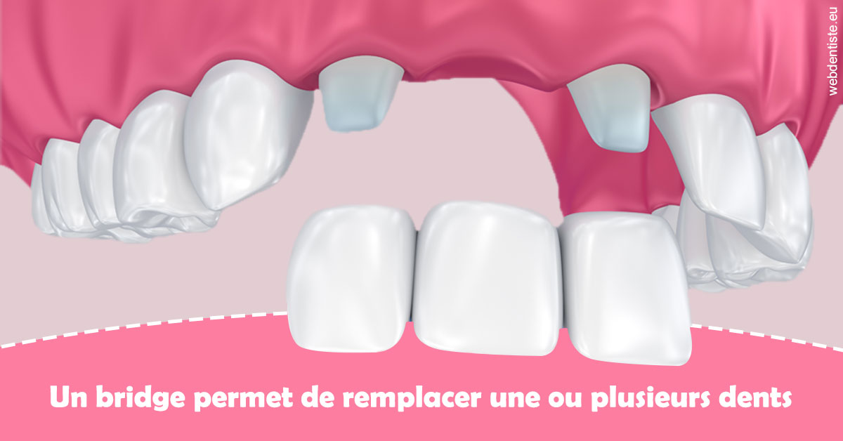 https://dr-brincat-thierry.chirurgiens-dentistes.fr/Bridge remplacer dents 2