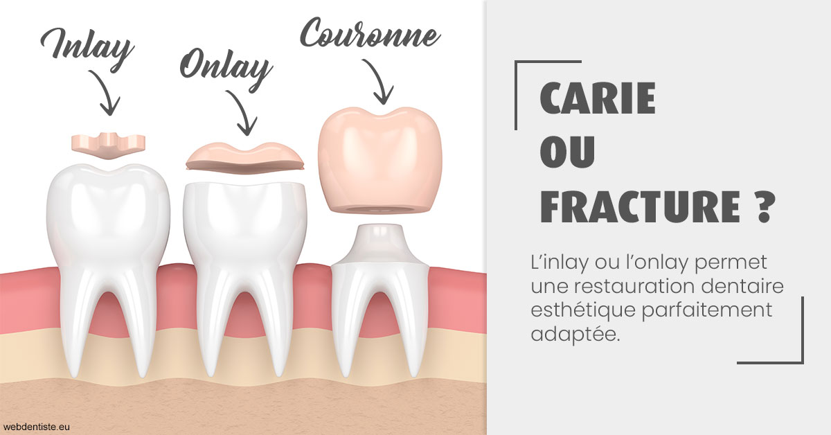 https://dr-brincat-thierry.chirurgiens-dentistes.fr/T2 2023 - Carie ou fracture 1