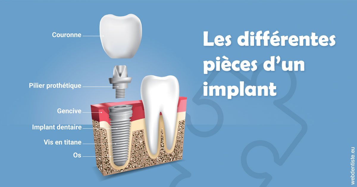 https://dr-brincat-thierry.chirurgiens-dentistes.fr/Les différentes pièces d’un implant 1